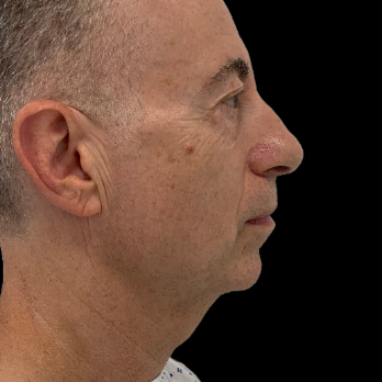 before-chin-implant