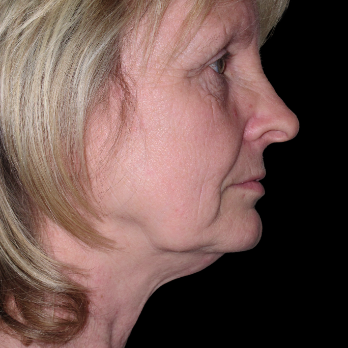 before-deep-plane-facelift-laser-resurfacing