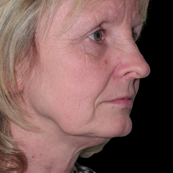 before-deep-plane-facelift-laser-resurfacing