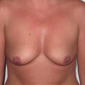 Front view of patient before Breast Augmentation Surgery