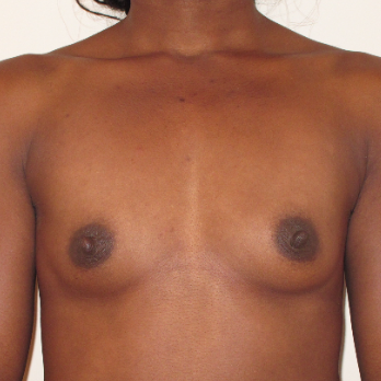 Front view of patient before Breast Augmentation Surgery