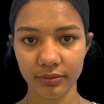 ethnic-rhinoplasty-before