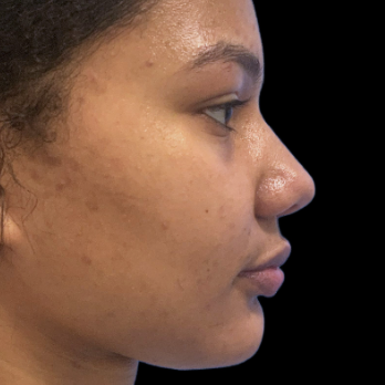 ethnic-rhinoplasty-before