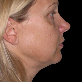 before-deep-plane-facelift