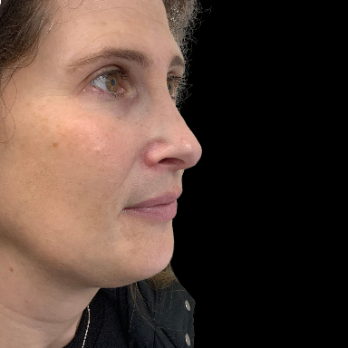 Ultrasonic-rhinoplasty-after