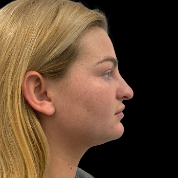 preservation-rhinoplasty-before