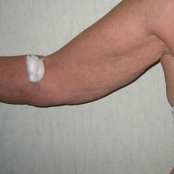 Front view of female patient before Brachioplasty Arm Lift surgery