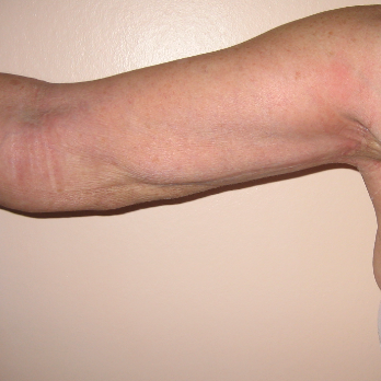 Front view of female patient after Brachioplasty Arm Lift surgery