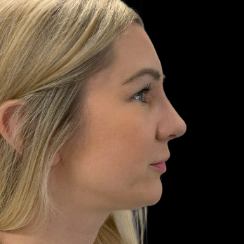 Ultrasonic-rhinoplasty-after