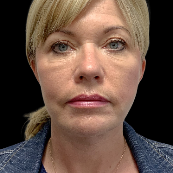 after-deep-plane-facelift-necklift-chin-implant
