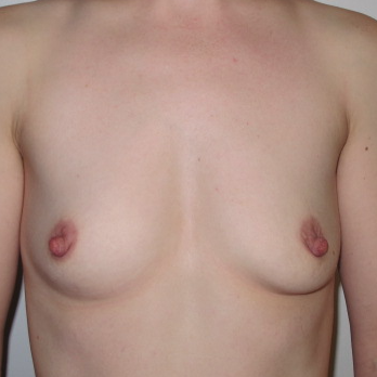 Front view of patient before Breast Augmentation Surgery