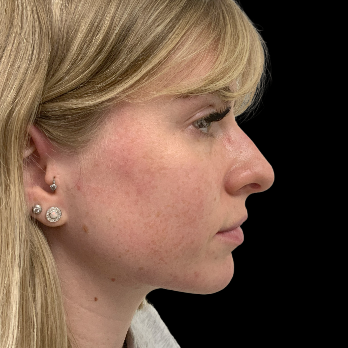 ultrasonic-rhinoplasty-before