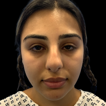 ethnic-rhinoplasty-before