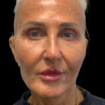 after-lip-lift