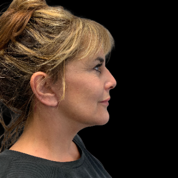 deepplane-facelift-after