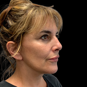 deepplane-facelift-after