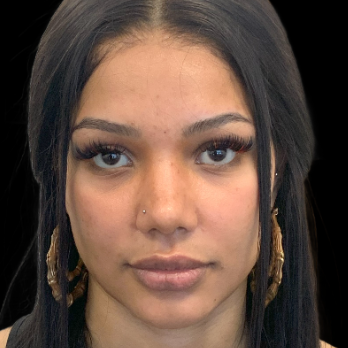 ethnic-rhinoplasty-after