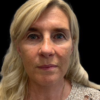deepplane-facelift-after