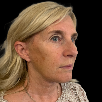 deepplane-facelift-after