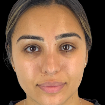 ethnic-rhinoplasty-after