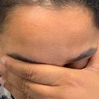 scarless-removal-forehead-osteoma