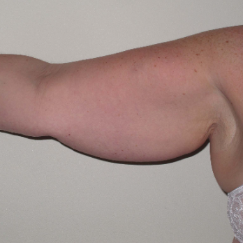 Front view of female patient before Brachioplasty Arm Lift surgery