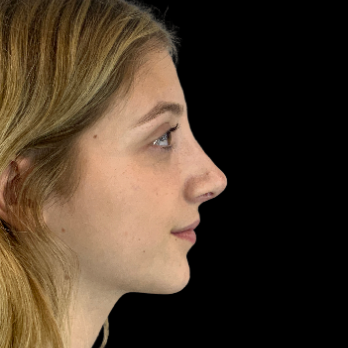 Ultrasonic-rhinoplasty-after