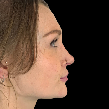 Ultrasonic-rhinoplasty-after