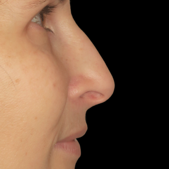 ultrasonic-rhinoplasty-before