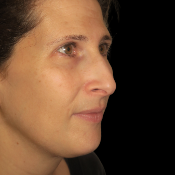 ultrasonic-rhinoplasty-before