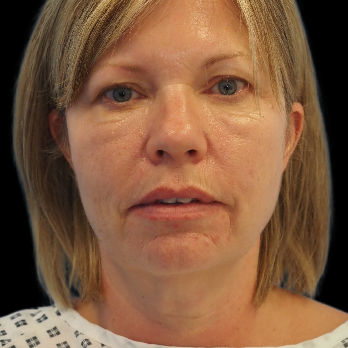 before-deep-plane-facelift-necklift-chin-implant