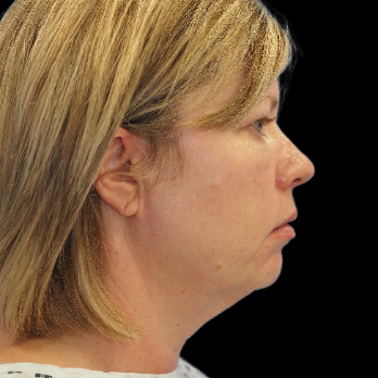 before-deep-plane-facelift-necklift-chin-implant