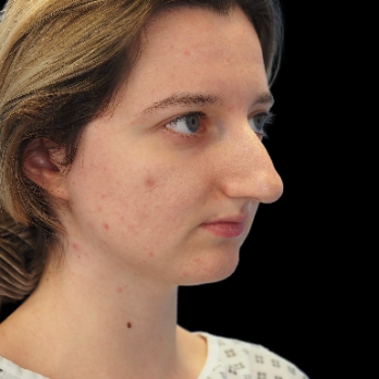 ultrasonic-rhinoplasty-before