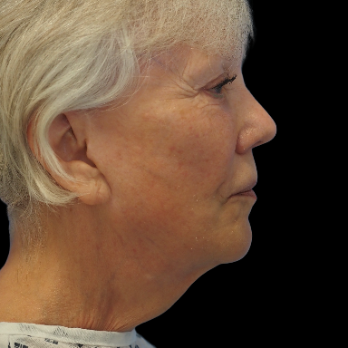 before-deep-plane-facelift-necklift