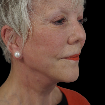 after-deep-plane-facelift-necklift