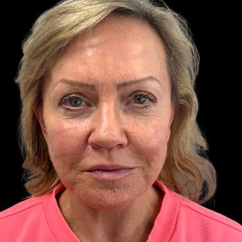 after-deep-plane-facelift-necklift-nanofat