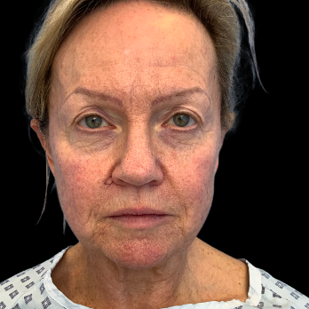 before-deep-plane-facelift-necklift-nanofat
