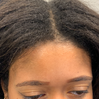 scarless-endoscopic-lipoma-removal