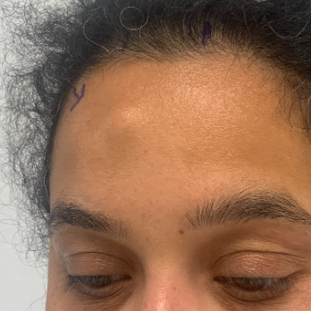 forehead-osteoid-osteoma