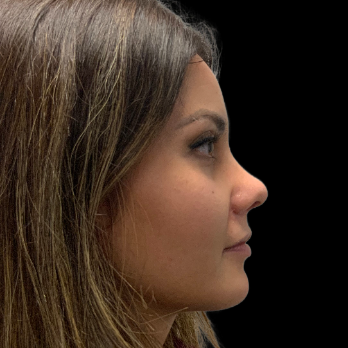 ethnic-rhinoplasty-after