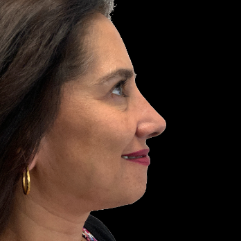 ethnic-rhinoplasty-after