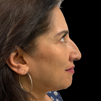 ethnic-rhinoplasty-before