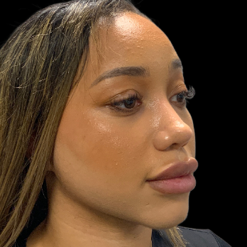 ethnic-rhinoplasty-after