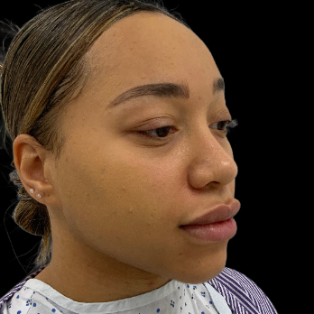 ethnic-rhinoplasty-before