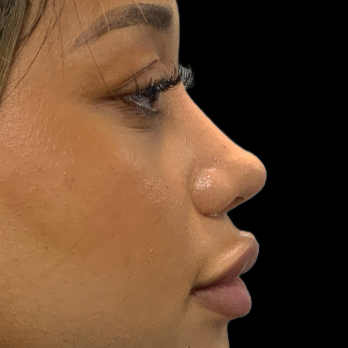 ethnic-rhinoplasty-after