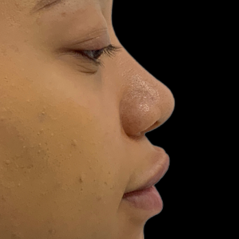 ethnic-rhinoplasty-before