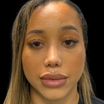 ethnic-rhinoplasty-after