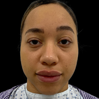 ethnic-rhinoplasty-before