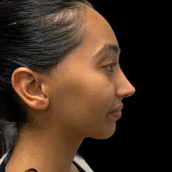 ethnic-rhinoplasty-after