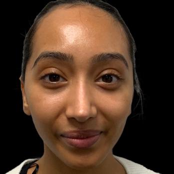 ethnic-rhinoplasty-after